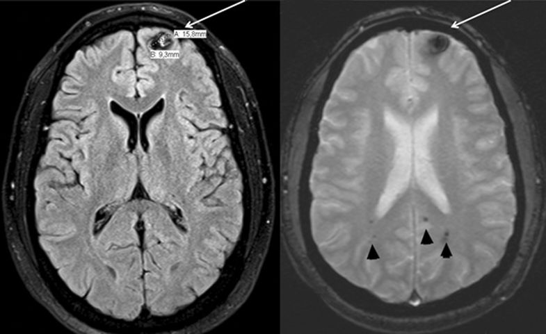 MRI of a cerebral cavernous malformation
