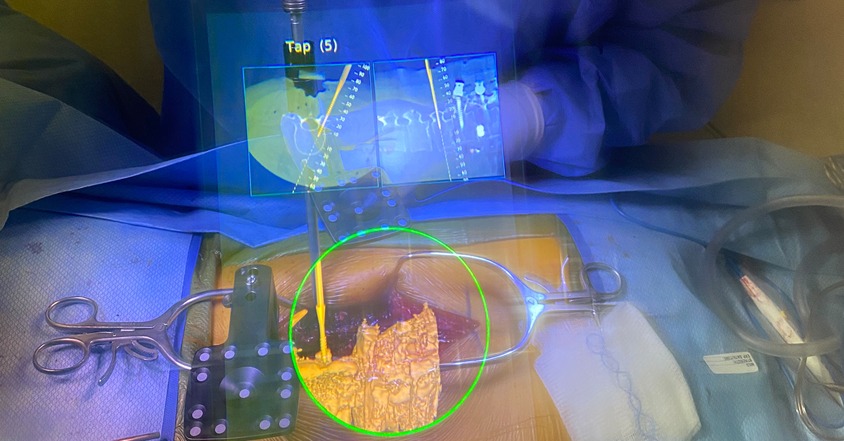 Surgeon wearing an augmented-reality headset during spine surgery